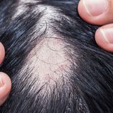 更年期に円形脱毛症になる原因｜円形脱毛症に対する予防と対処法